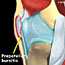 Bursitis