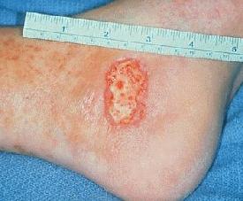varicose ulcer images